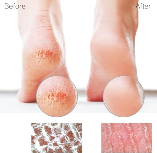 Glass Foot File Callus Remover for Feet, Heel Scraper, Pumice Stone, Diabetic Feet Scrubber Dead Skin Remover for Feet Professional Pedicure Tools - color: Coarse-pro